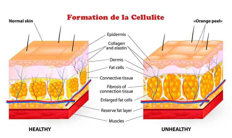 Diagrame montrant la formation de la cellulite.